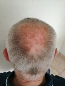 Typical male pattern baldness